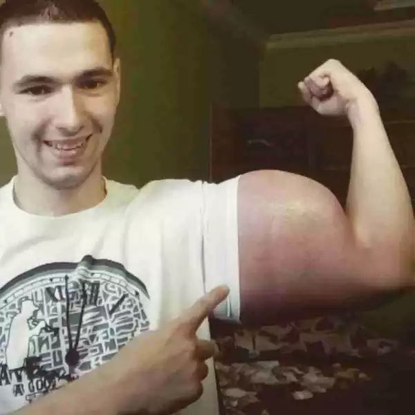 Trouble: This Man May Soon Have His Hands Cut Off After Injecting His Arms With Oil To Look Big (Photos) 
